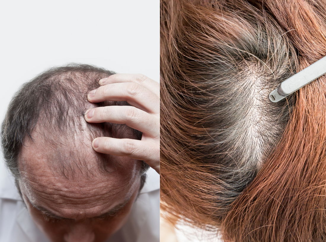 Does Testosterone Cause Hair Loss?