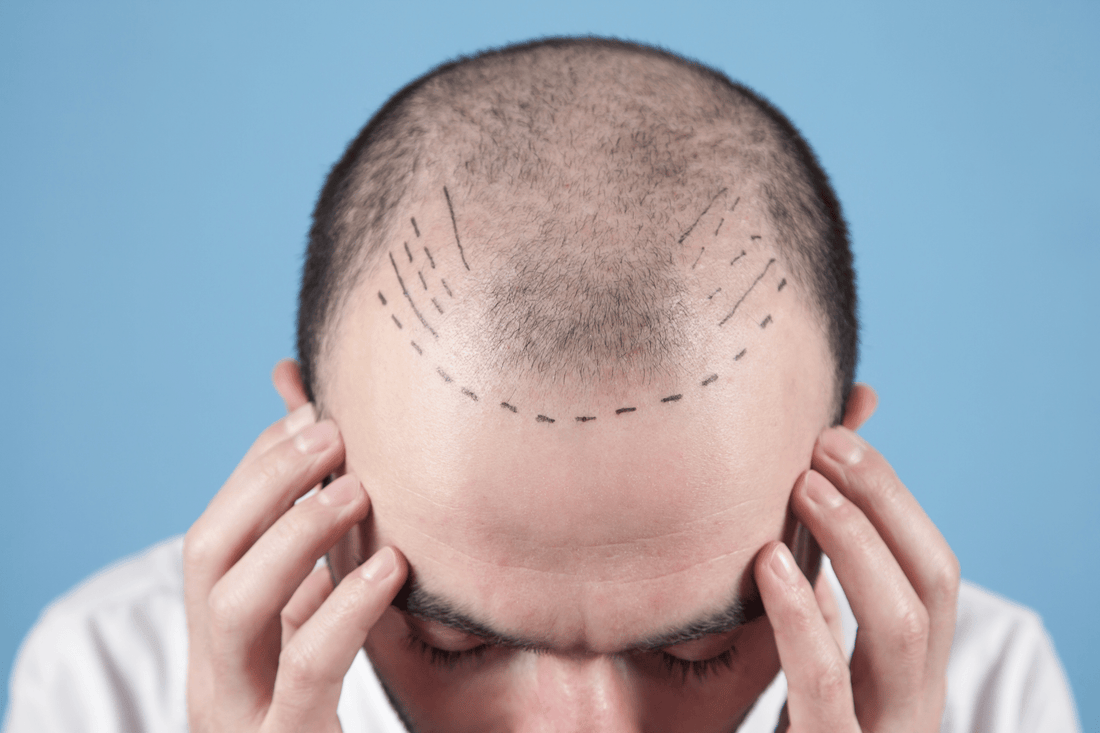 bad hair transplant downsides