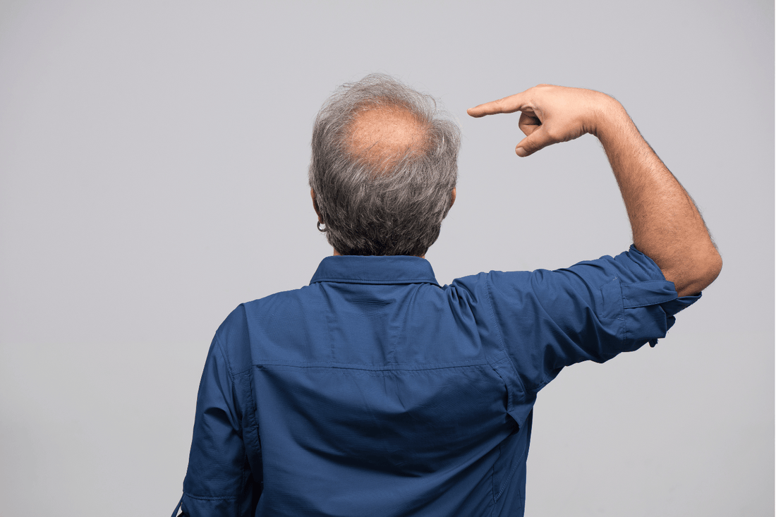 fixing a balding crown