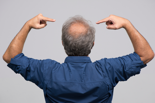 Understanding Signs and Stages of Male Pattern Baldness