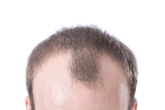 uneven hairline