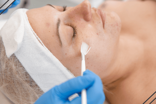 How Soon After A Chemical Peel Can I Use Retinol?